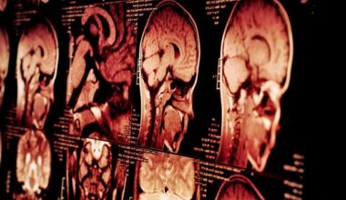 Mini-Brains and AI Spot Schizophrenia With 92% Accuracy