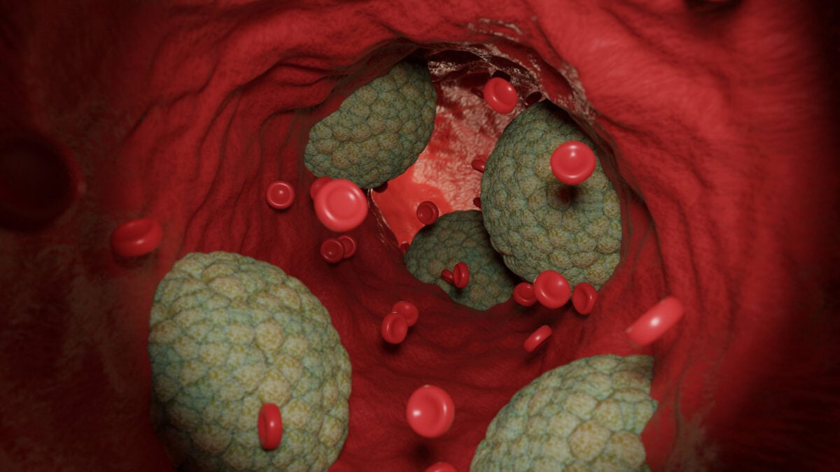 Some Heart Attacks Might Be Triggered by Germs