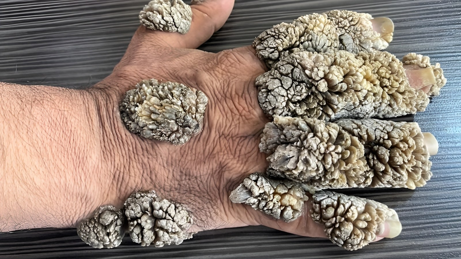 tree man syndrome
