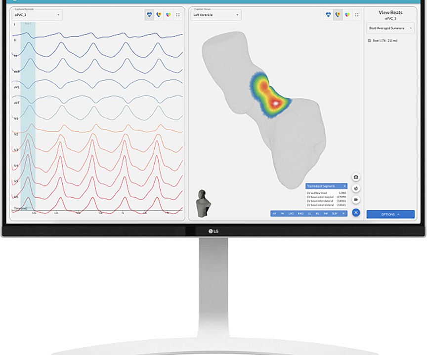 New AFib detection device being tested in Jacksonville