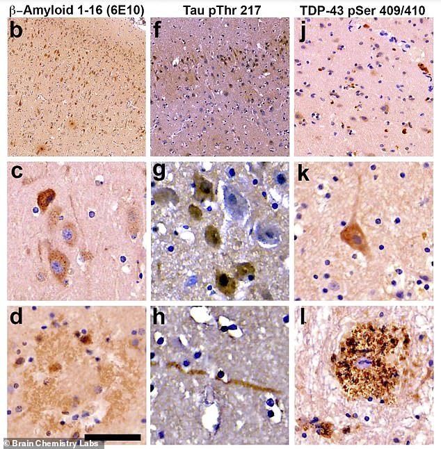Scientists found the hallmarks of Alzheimer's in the brains of all the dolphins tested, including misfolded tau proteins (center), amyloid plaques (left) and tangled fibers (right) that destroy neural connections