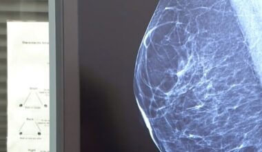 Estonia's personalized medicine law will test women for breast cancer based on genetic data | News