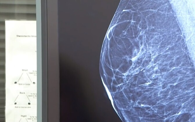 Estonia's personalized medicine law will test women for breast cancer based on genetic data | News