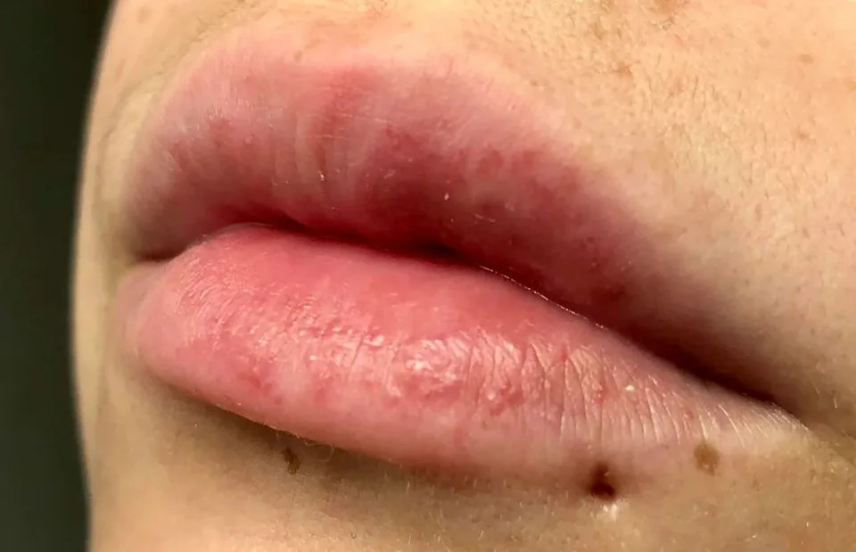 Close-up of a person's lips and lower face, highlighting natural skin texture and faint freckles