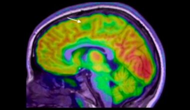 New AI Tool Finds Hidden Brain Lesions That Doctors Miss in Children With Epilepsy : ScienceAlert