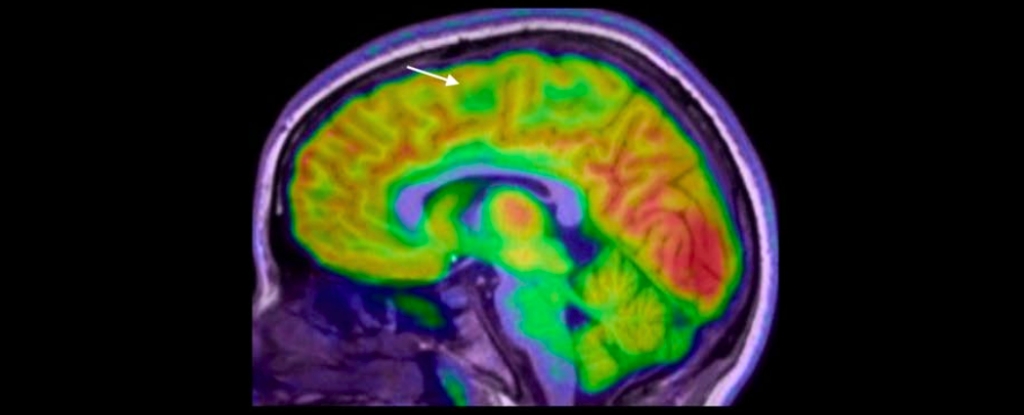 New AI Tool Finds Hidden Brain Lesions That Doctors Miss in Children With Epilepsy : ScienceAlert