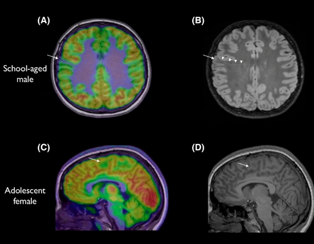 Two color brain scans next to two matching gray scans