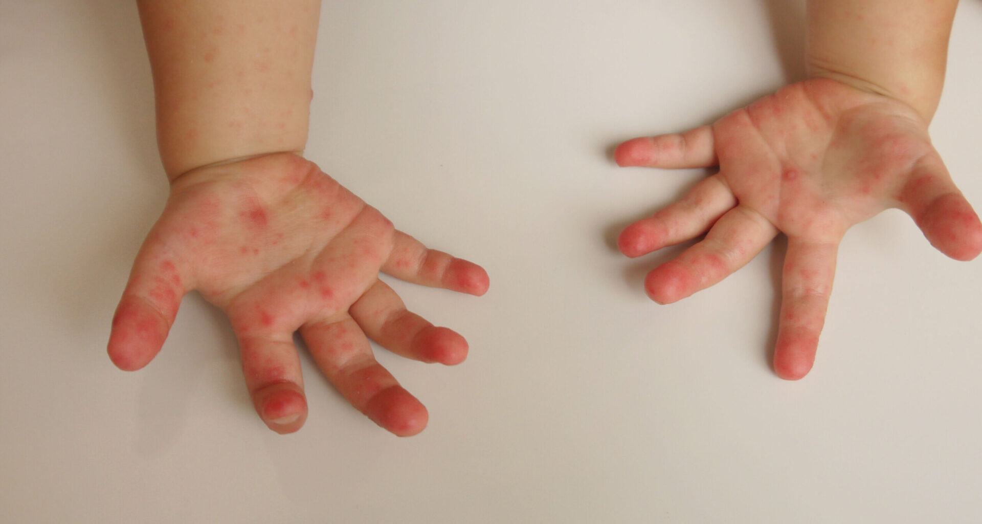 Warning issued over spike in hand, foot and mouth disease in Prince George’s schools