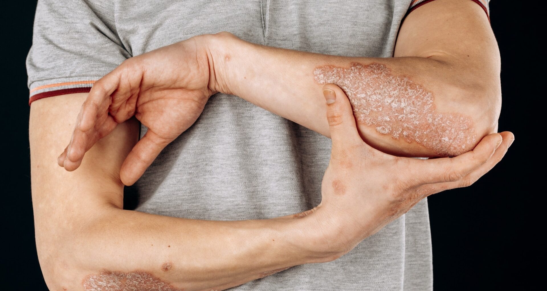 Study: Causal Relationships Between Popular Diets (Low-Calorie, Vegetarian, and Gluten-Free Diets) and Inflammatory Skin Diseases: A Mendelian Randomization Study. Image Credit: Fuss Sergey / Shuttertock