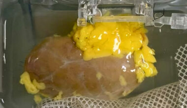 Scientists Create 'Universal' Kidney To Match Any Blood Type : ScienceAlert