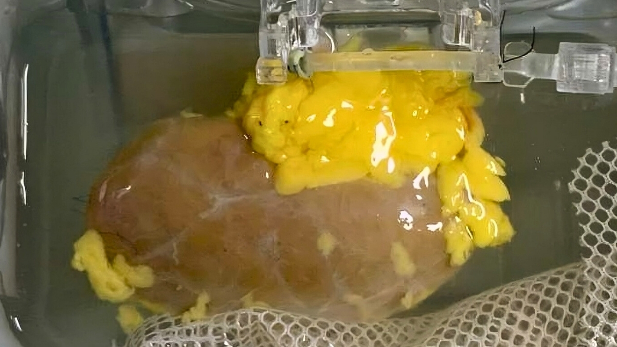 Scientists Create 'Universal' Kidney To Match Any Blood Type : ScienceAlert