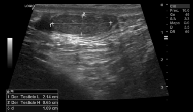 When Genetics Meet Hormones: Infertility and Normogonadotropic Hypogonadism From Robertsonian Translocation (14;21)