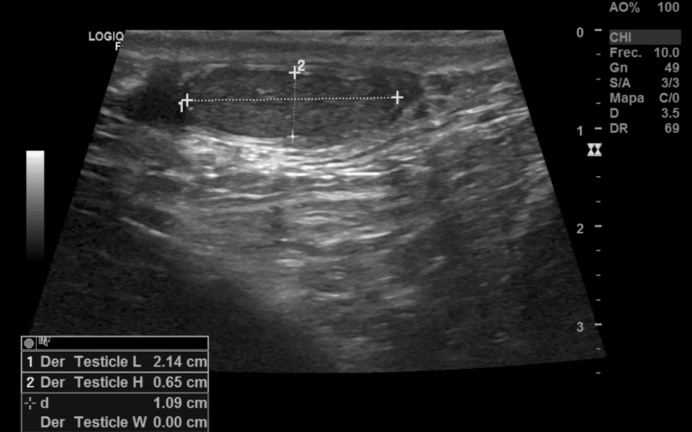 When Genetics Meet Hormones: Infertility and Normogonadotropic Hypogonadism From Robertsonian Translocation (14;21)