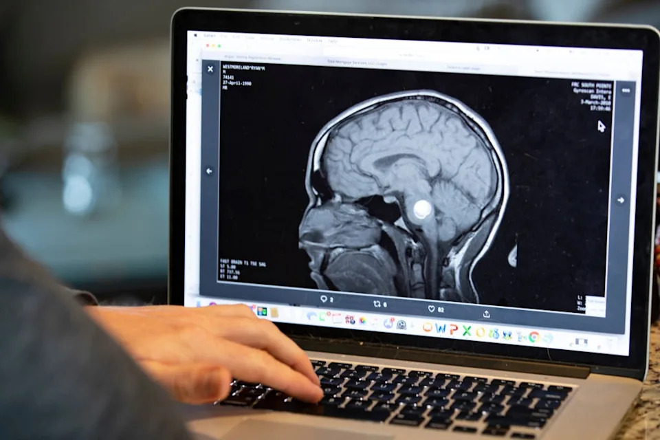 Person analyzing a brain MRI on a laptop screen, focusing on a specific area. Hands visible typing on the keyboard