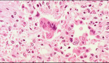 Measles detection in Marion County wastewater prompts OHA alert to health care providers