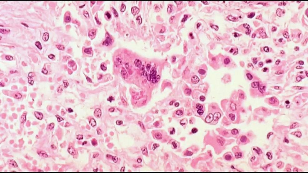 Measles detection in Marion County wastewater prompts OHA alert to health care providers