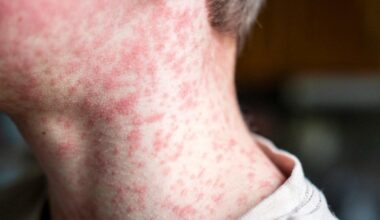139 unvaccinated students quarantining after measles exposure at South Carolina schools