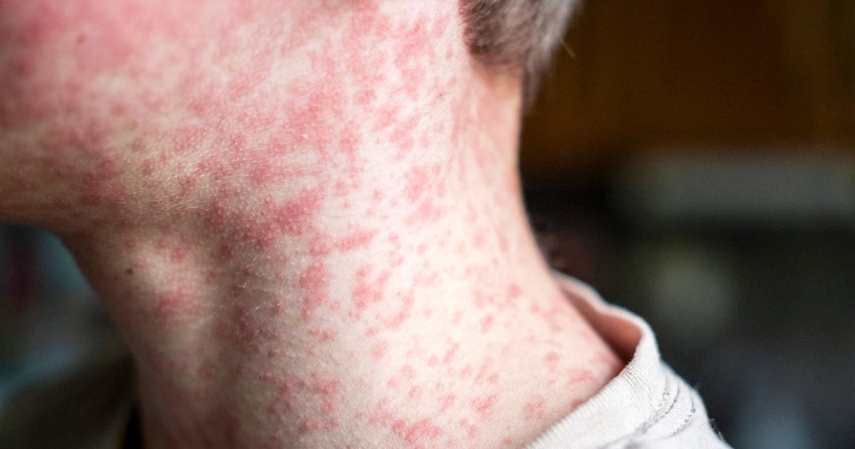139 unvaccinated students quarantining after measles exposure at South Carolina schools