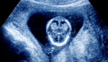 Gene-activity map of developing brain reveals new clues about autism’s sex bias