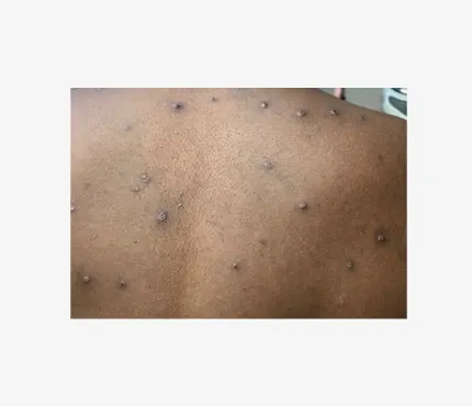 An example of mpox rash. The rash, especially in initial stages, can appear as raised bumps.