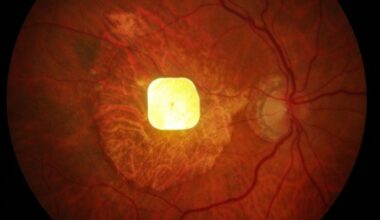 Revolutionary Prosthetic Eye Chip Restores Sight in Medical First : ScienceAlert