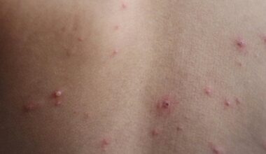 Third case of measles for 2025 confirmed in Cook County