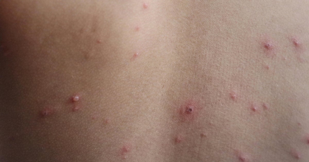 Third case of measles for 2025 confirmed in Cook County