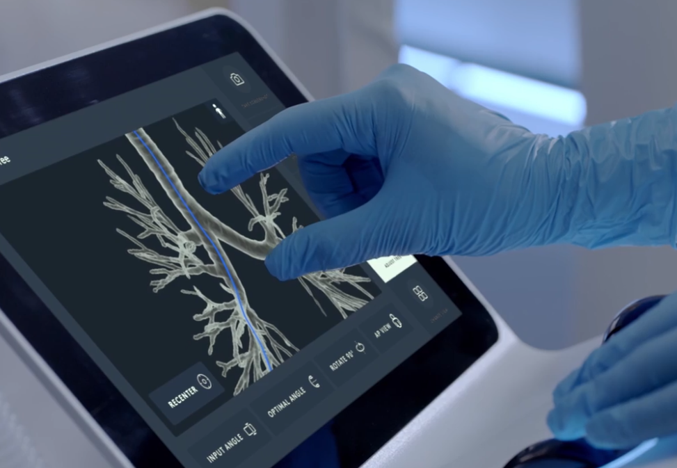 Most lung cancer is diagnosed at Stage 4: How Md. health system catches 40% at Stage 1