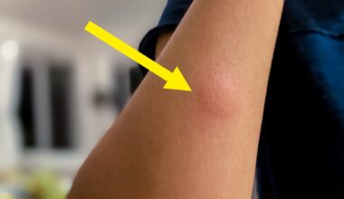 Never Do This After A Mosquito Bite