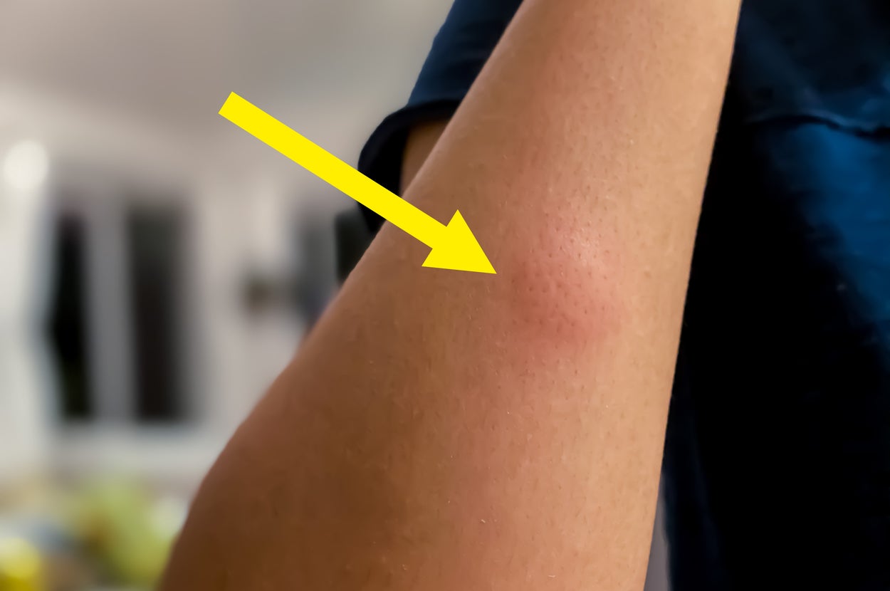 Never Do This After A Mosquito Bite