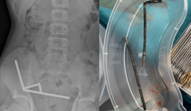 Surgeons remove dozens of magnets from teen's stomach