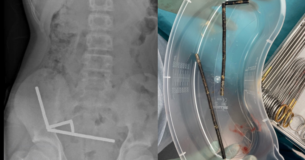 Surgeons remove dozens of magnets from teen's stomach