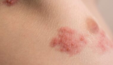 Shingles Shots Don’t Just Prevent Pain—They Might Save Your Life