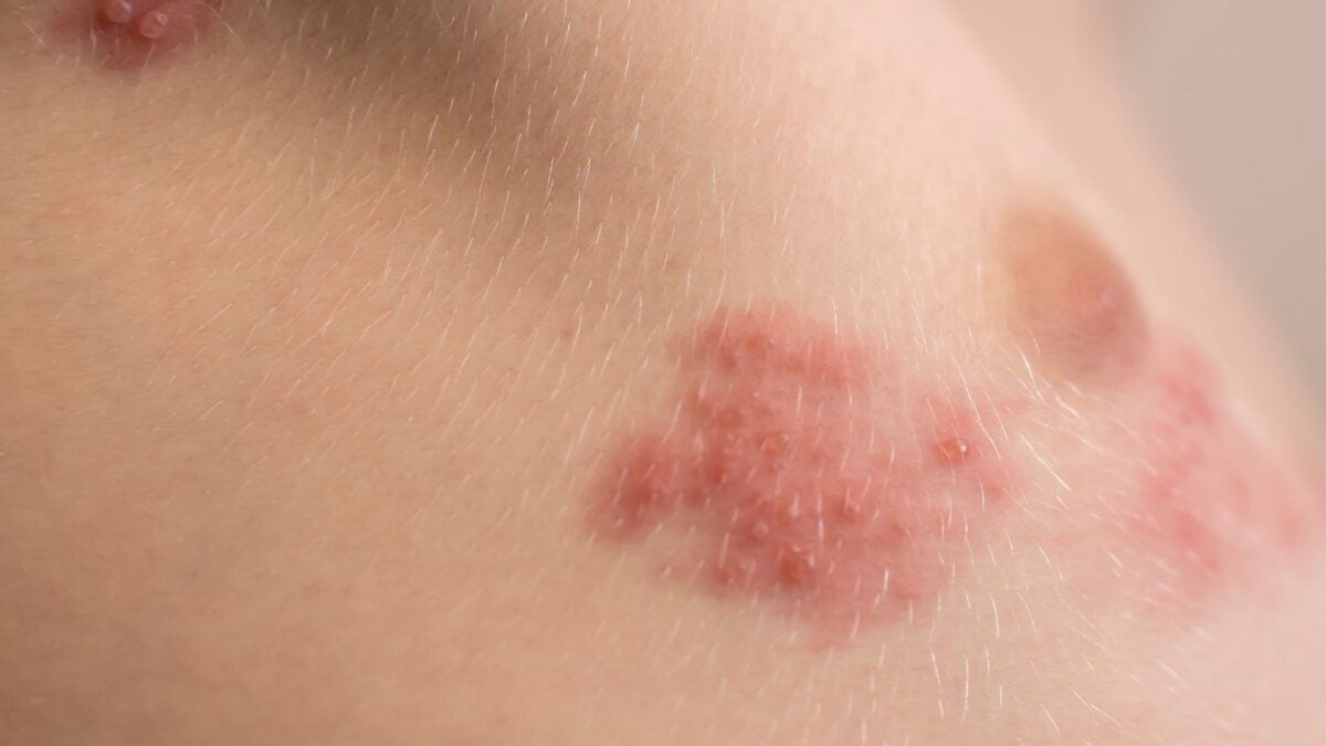 Shingles Shots Don’t Just Prevent Pain—They Might Save Your Life