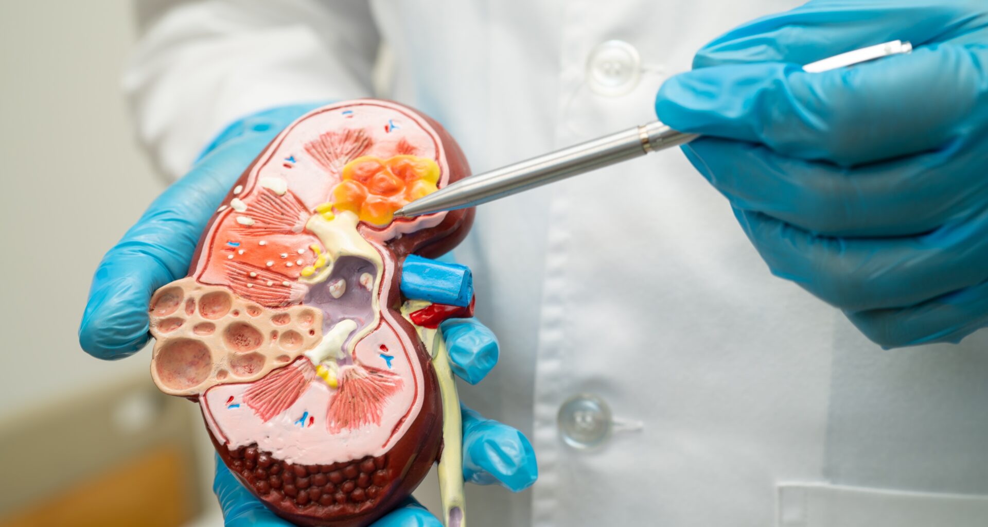 Kidney organoids show APOL1 gene’s role in chronic kidney disease