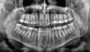 Losing Your Teeth Could Be a Deadly Warning, Study Finds : ScienceAlert