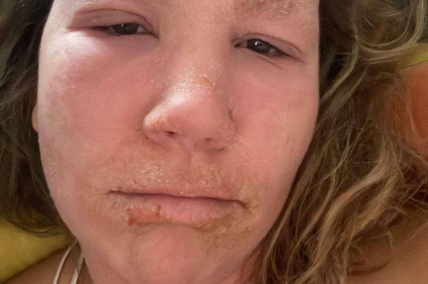 Picture showing Lily with red and flaking skin