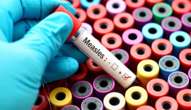 Second doctor at Ichilov Hospital tests positive for measles