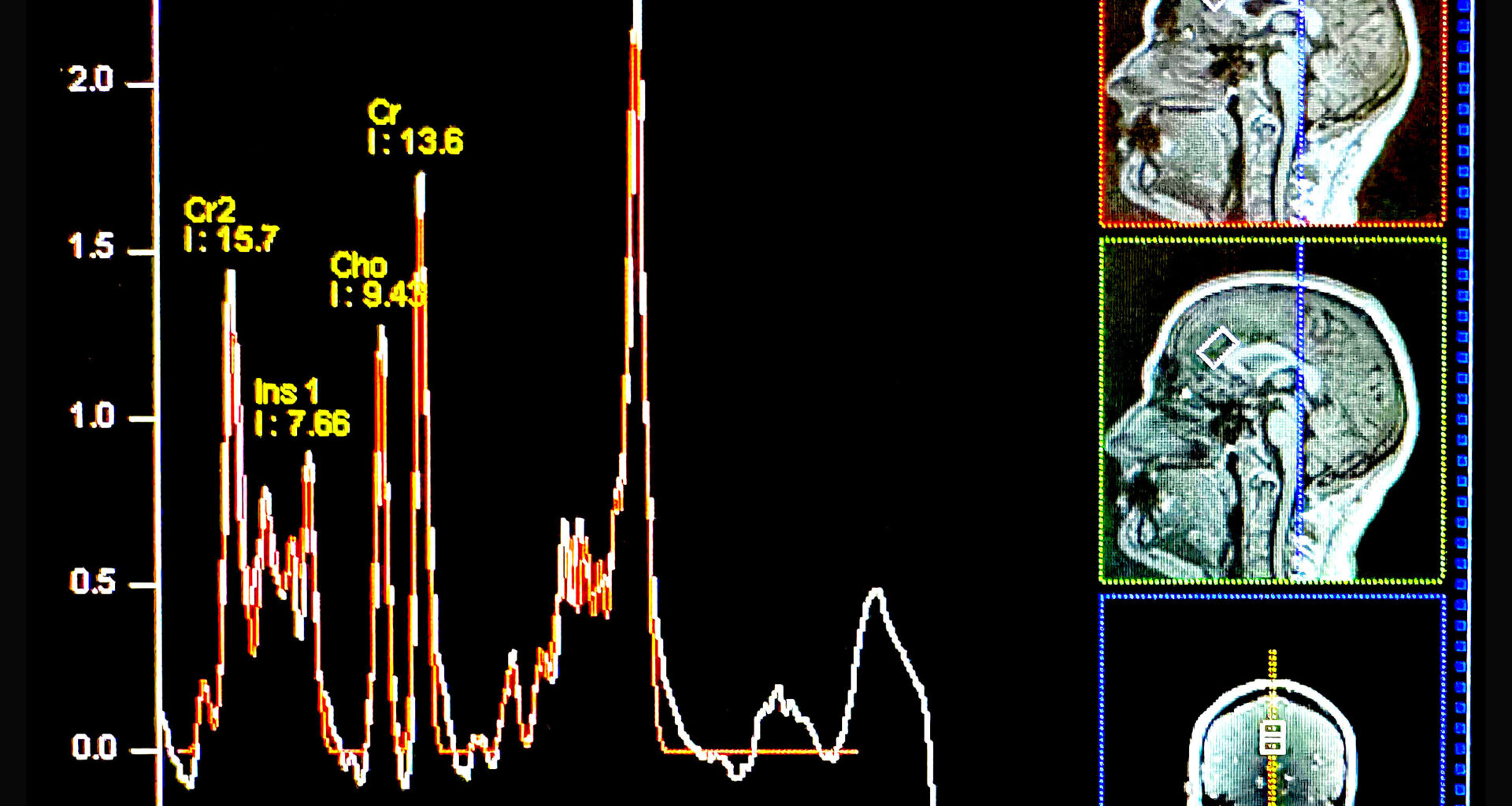 Anxiety disorders tied to low levels of an essential nutrient in the brain