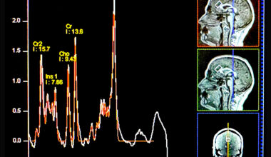 Anxiety disorders tied to low levels of an essential nutrient in the brain