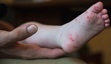 Hand, foot and mouth disease on rise in certain areas: Doctor explains symptoms, if it's contagious, risk for adults and kids
