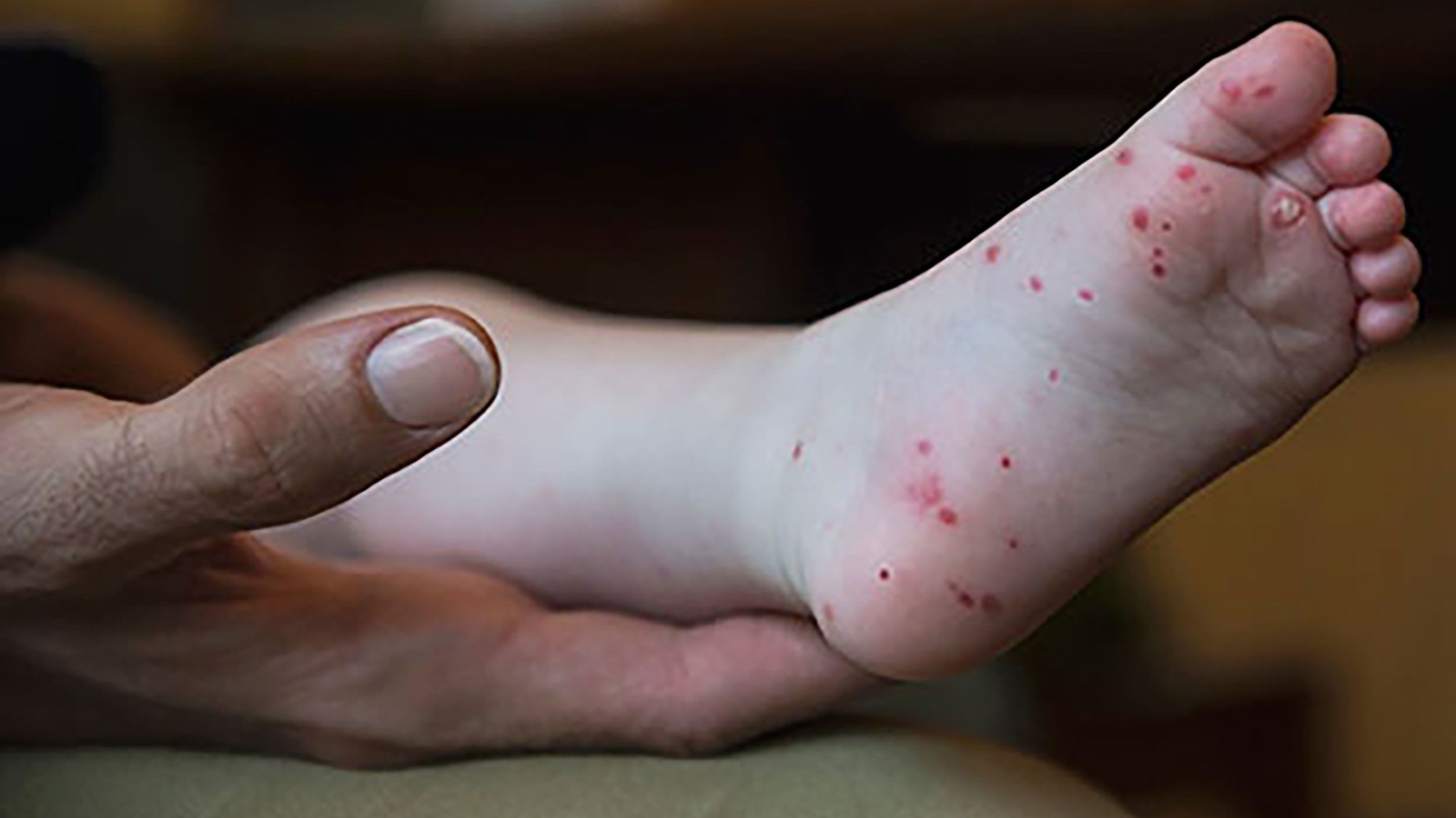 Hand, foot and mouth disease on rise in certain areas: Doctor explains symptoms, if it's contagious, risk for adults and kids