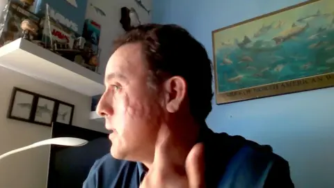 Mauricio Hoyos shows the scar left on his cheek by a Galapagos shark attack