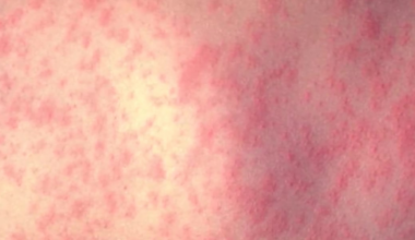 Third measles case of 2025 in La. reported