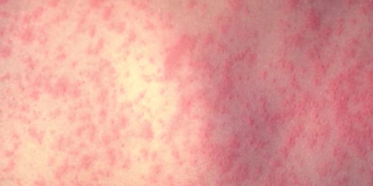 Third measles case of 2025 in La. reported