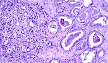 Prostate Cancer Patients Offered Fresh Hope by Promising New Drug Combination