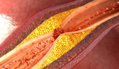 Amgen's Repatha cholesterol shot slashed heart attack risk by 36%