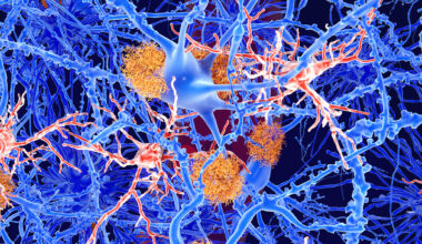 One of Our Biggest Hopes For Alzheimer's Treatment Doesn't Seem to Work : ScienceAlert