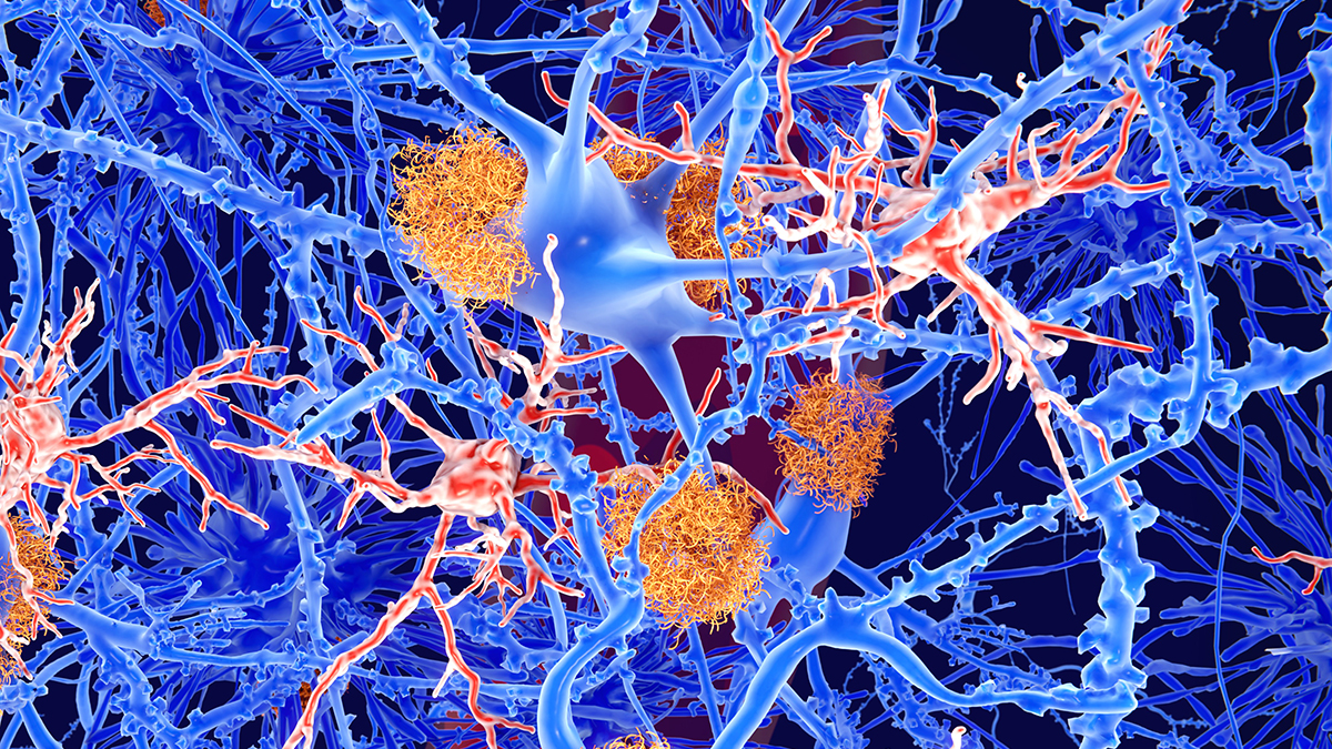 One of Our Biggest Hopes For Alzheimer's Treatment Doesn't Seem to Work : ScienceAlert