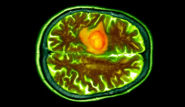 Nasal Drops Could Help Fight a Common And Deadly Brain Cancer : ScienceAlert